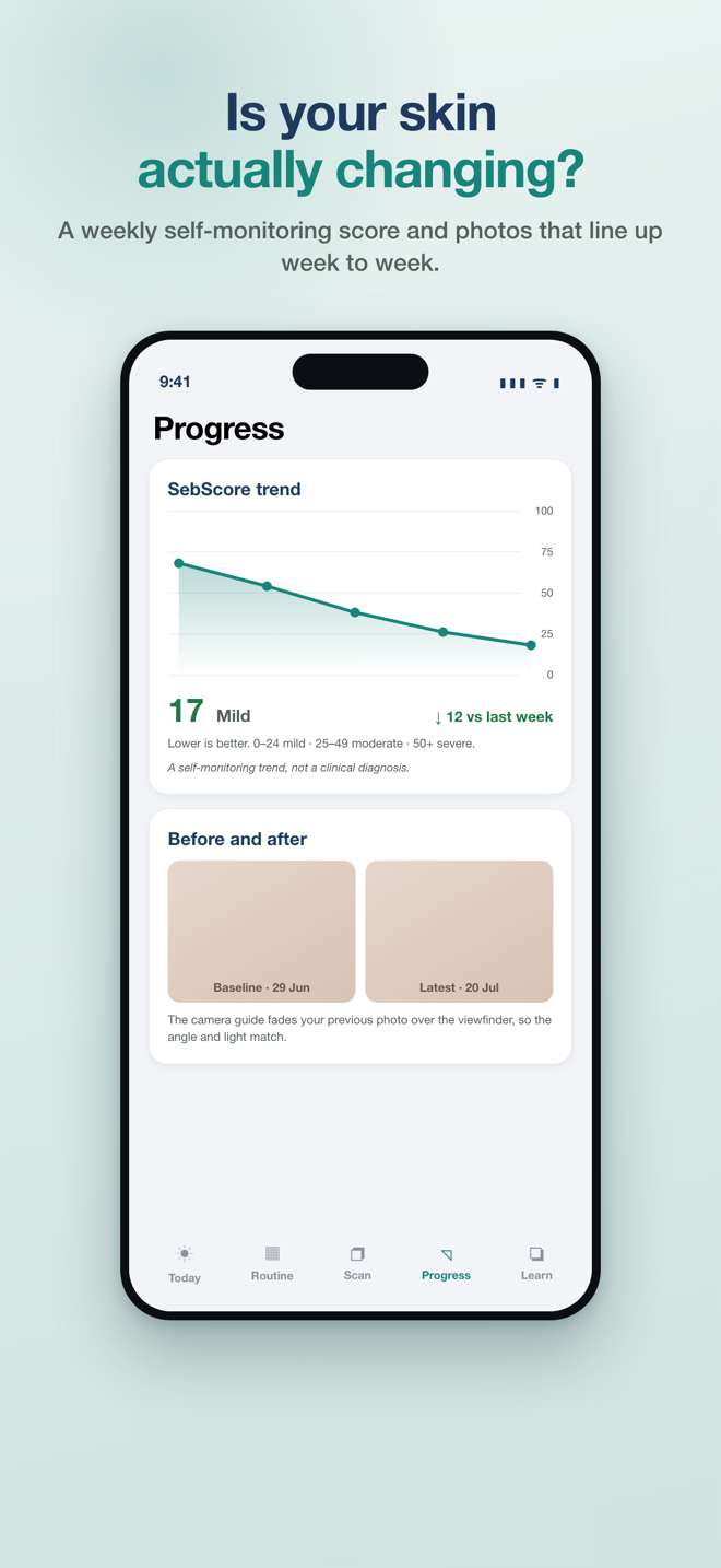 SebDerm progress screen showing a weekly self-monitoring score trend and a before and after photo pair aligned to the same angle